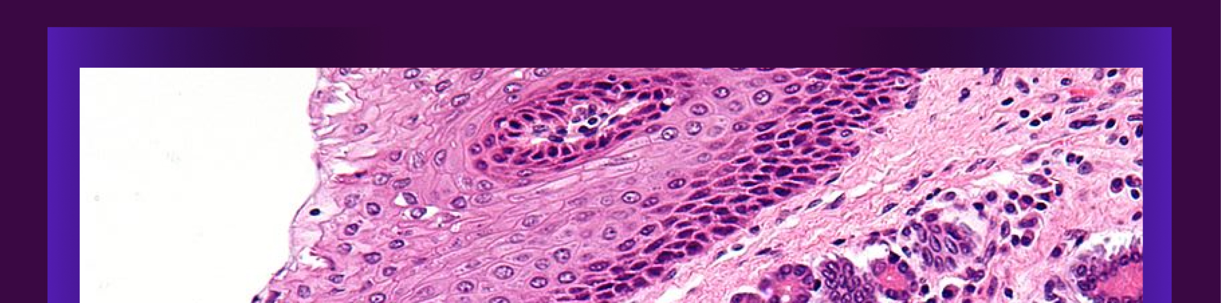 Vista microscópica de muestra para análisis patológico, con formas circulares e irregulares con tonos morados.